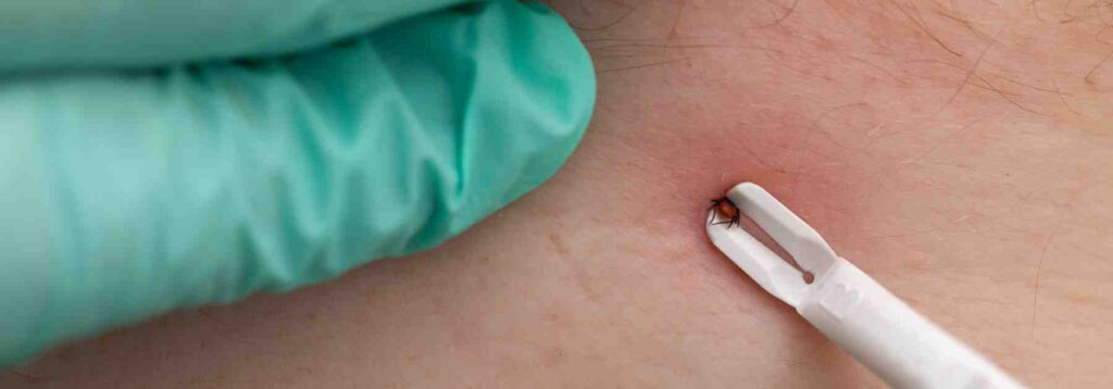 Pack a travel first aid kit for tick bites, sunburn, and more. 